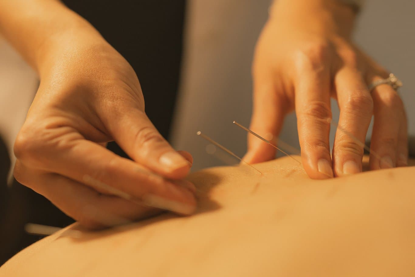 Acupuncture