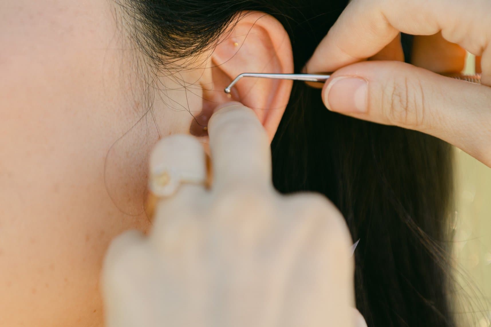 Auricular Therapy