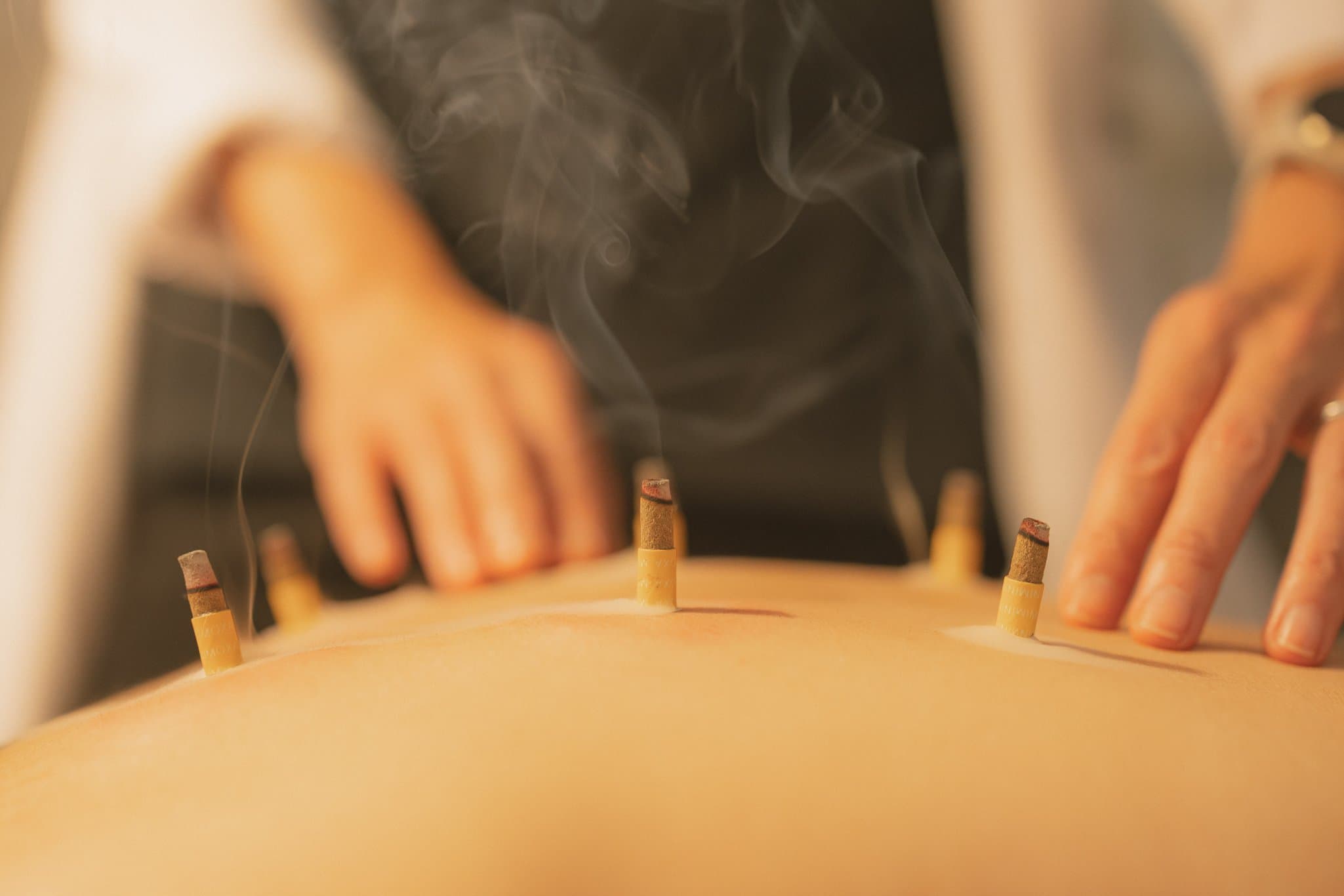 Moxibustion